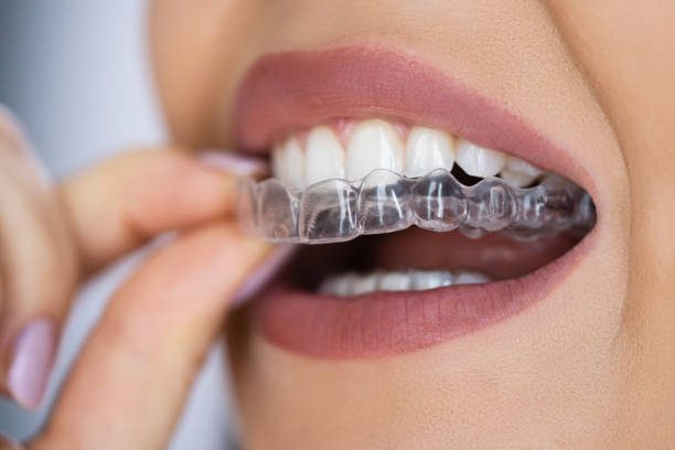 Patient inserting a clear aligner